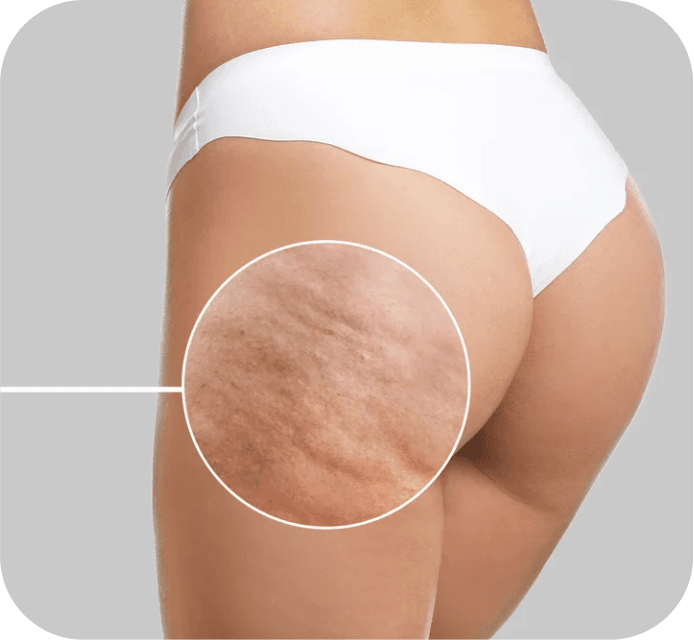 Cellulite Reduction