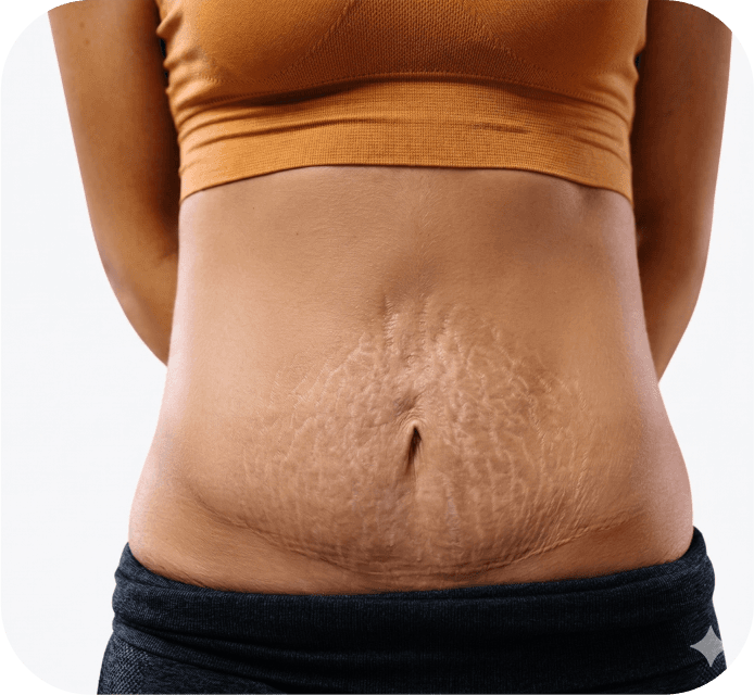 Stretch Mark Treatment