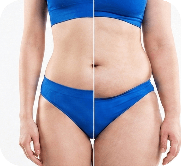 Post-Weight Loss Correction