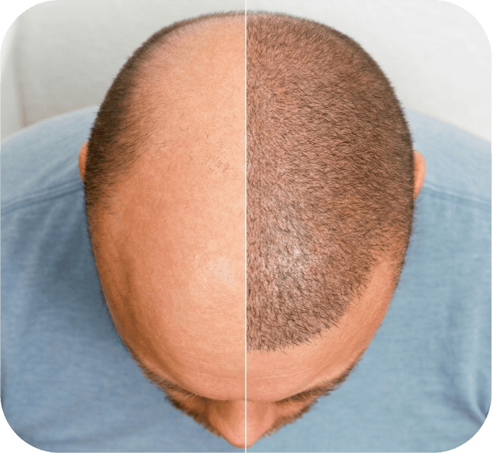 Hair Transplant