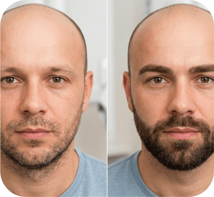 Beard Eyebrow Transplant