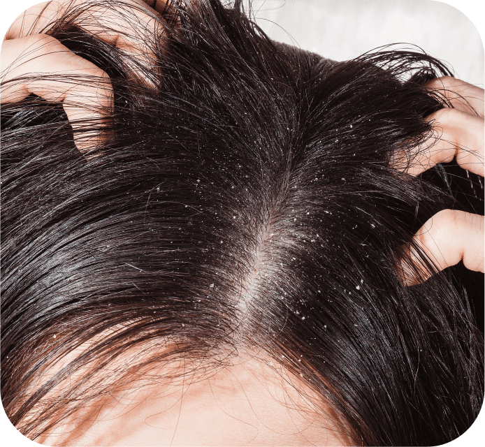 Scalp Disorders
