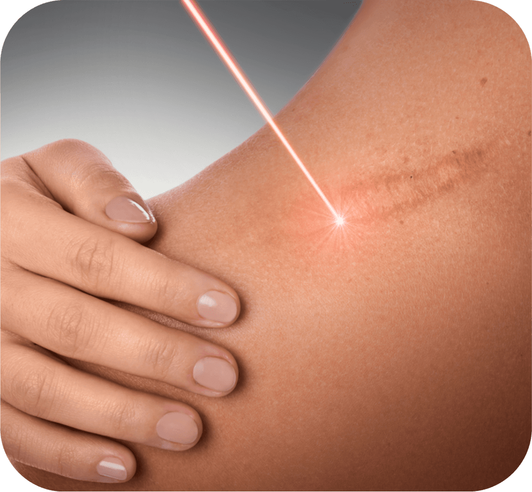 Scar Revision